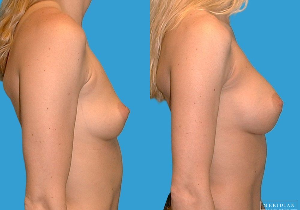 Breast Augmentation - Thumbnail 2