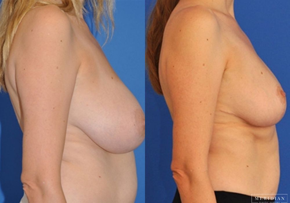 Breast Reduction - Thumbnail 2