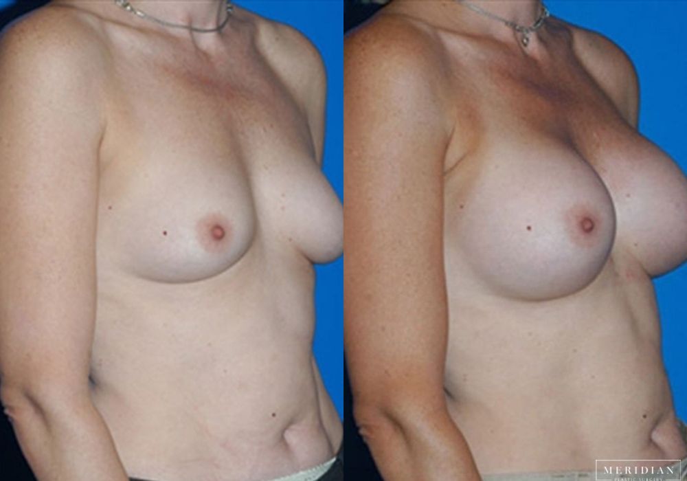 Breast Augmentation - Thumbnail 2