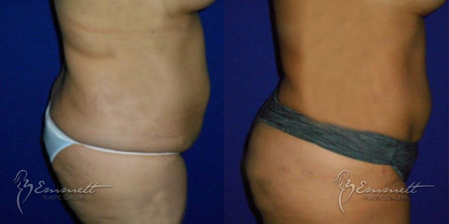 Brazilian Butt Lift - Case 24435