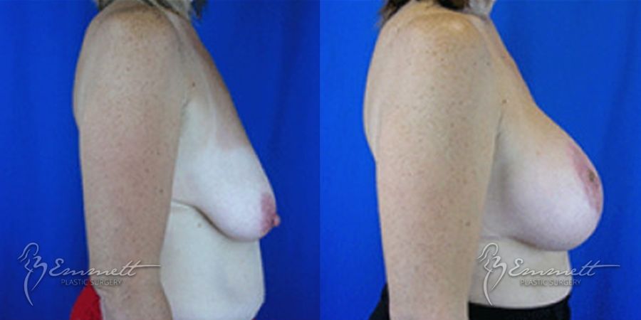 Breast Augmentation - Thumbnail 2