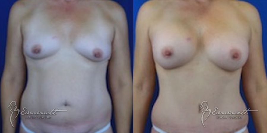 Breast Augmentation - Case 24395