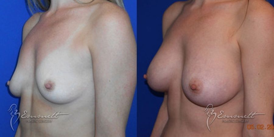 Breast Augmentation - Thumbnail 2