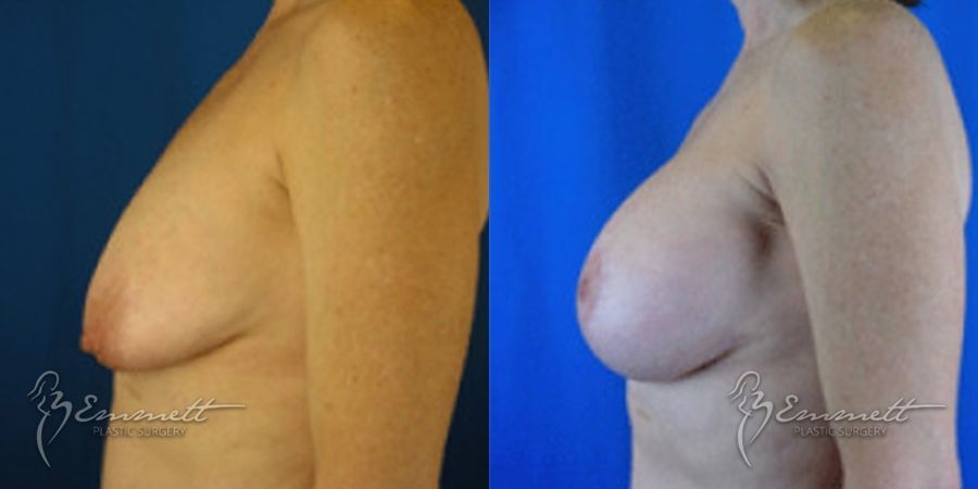 Breast Augmentation - Thumbnail 4