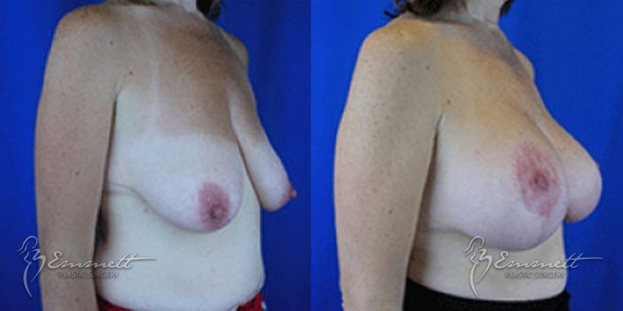 Breast Augmentation - Case 24399