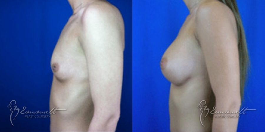 Breast Augmentation - Thumbnail 4