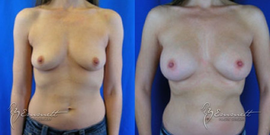 Breast Augmentation - Case 24406