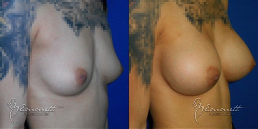Breast Augmentation - Thumbnail 2