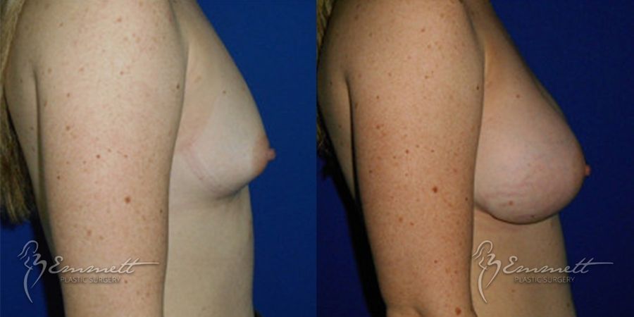 Breast Augmentation - Thumbnail 2