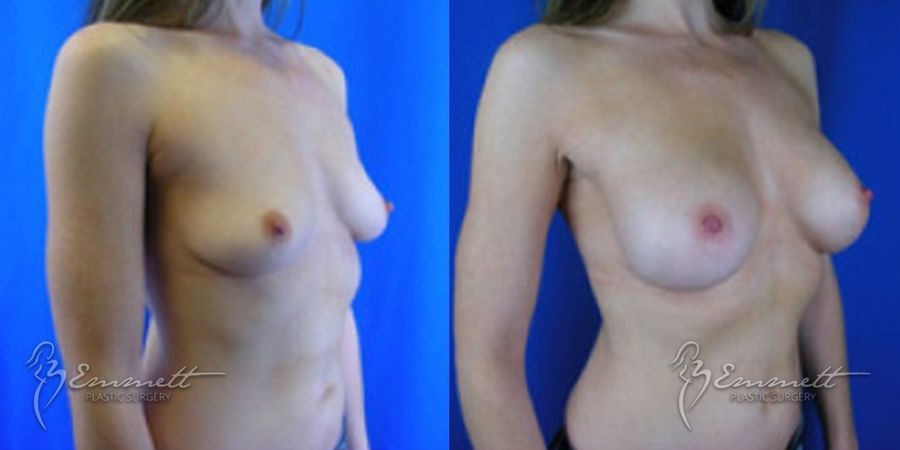 Breast Augmentation - Thumbnail 2