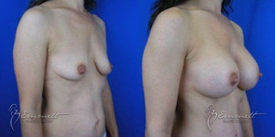 Breast Augmentation - Thumbnail 2