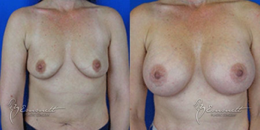 Breast Augmentation - Case 24400