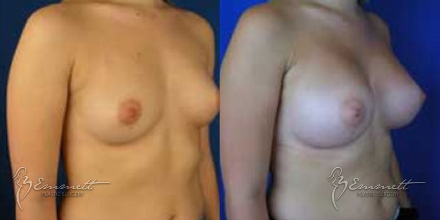 Breast Augmentation - Thumbnail 2