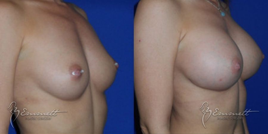 Breast Augmentation - Thumbnail 2