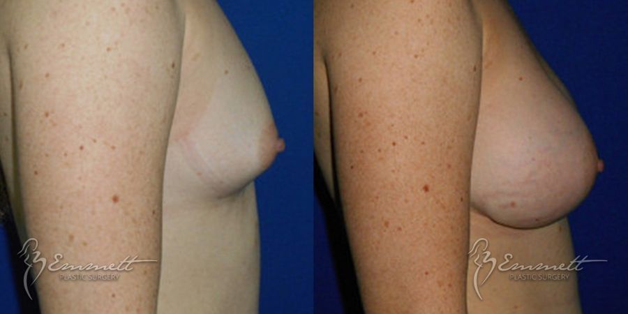 Breast Augmentation - Thumbnail 2