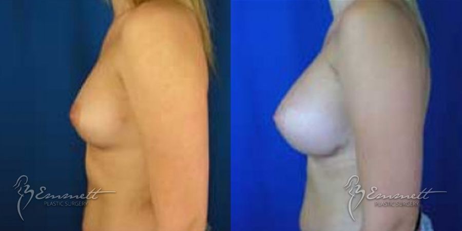 Breast Augmentation - Thumbnail 4
