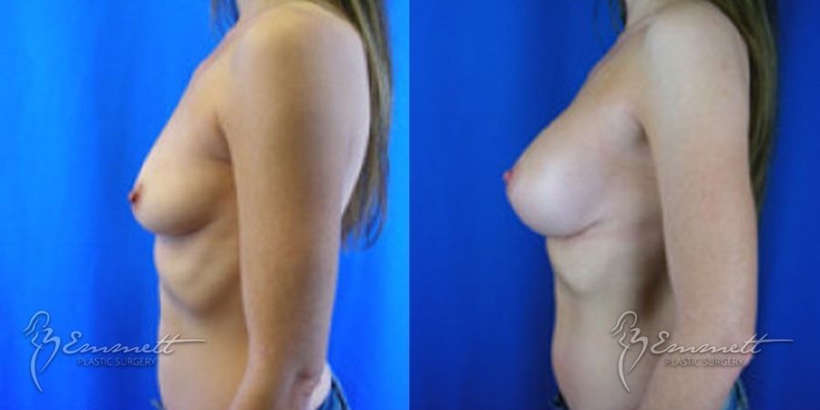 Breast Augmentation - Thumbnail 3