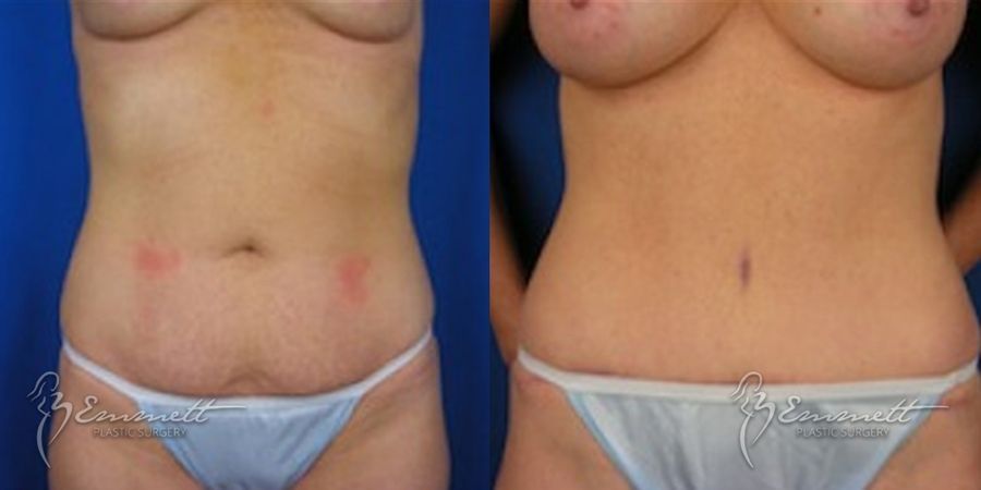 Breast Augmentation - Thumbnail 4