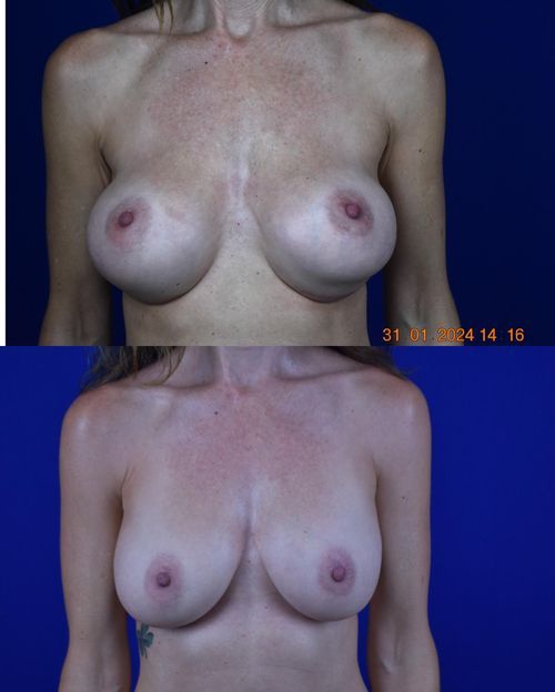 Breast Augmentation - Case 24446
