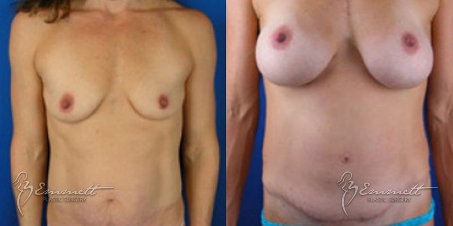 Breast Augmentation - Case 24407