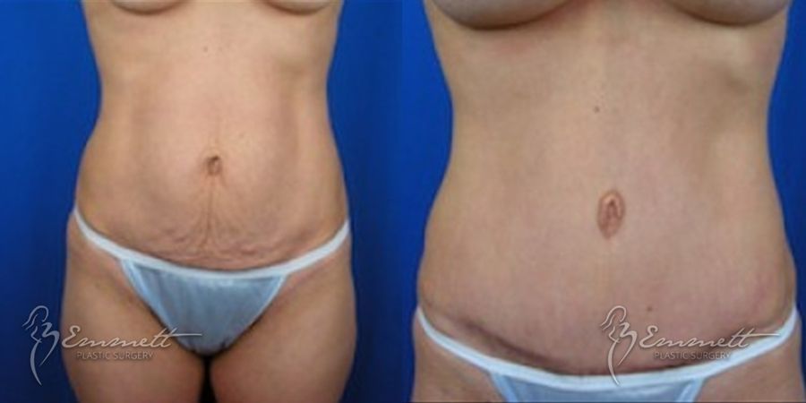Breast Augmentation - Thumbnail 4