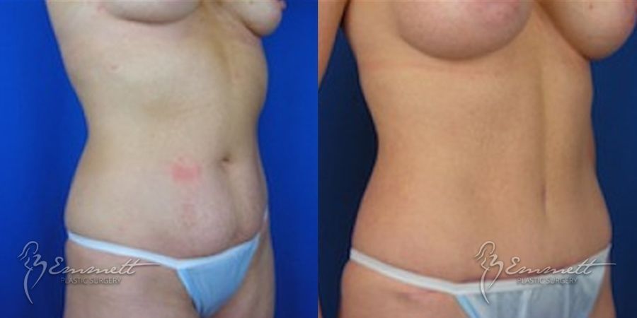 Breast Augmentation - Thumbnail 5