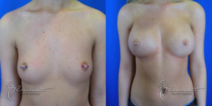 Breast Augmentation - Case 24405