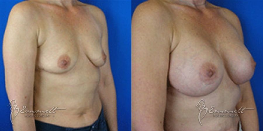 Breast Augmentation - Thumbnail 2