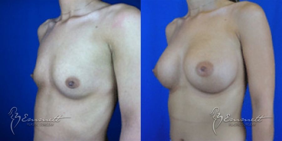 Breast Augmentation - Thumbnail 3