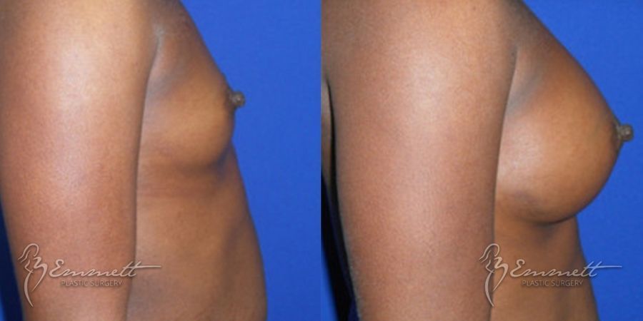Breast Augmentation - Thumbnail 3