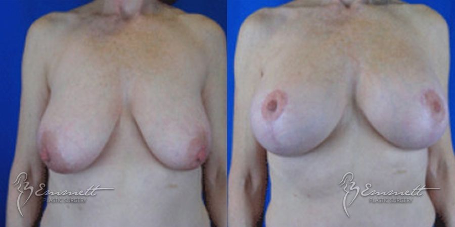 Breast Augmentation - Case 24402