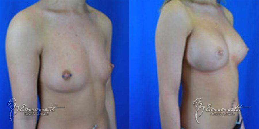 Breast Augmentation - Thumbnail 2