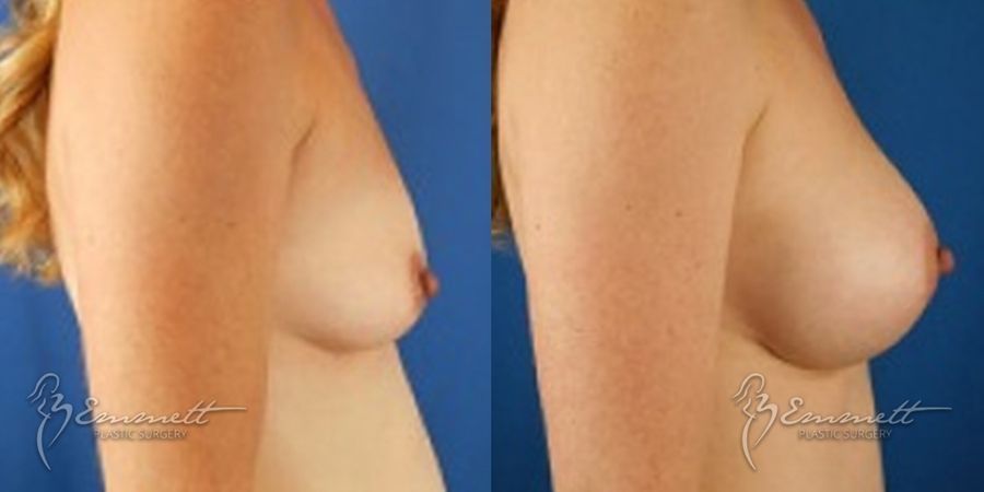 Breast Augmentation - Thumbnail 2