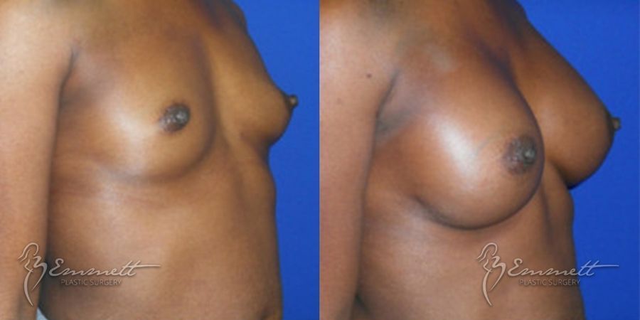 Breast Augmentation - Thumbnail 2
