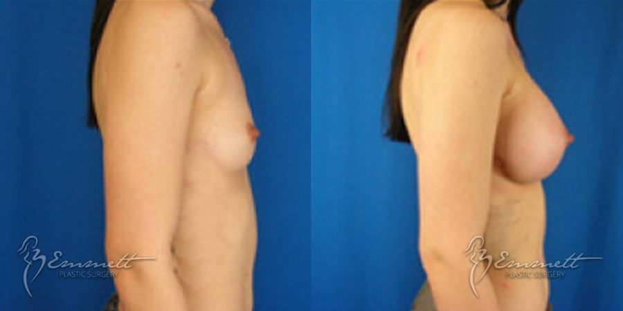 Breast Augmentation - Case 24404