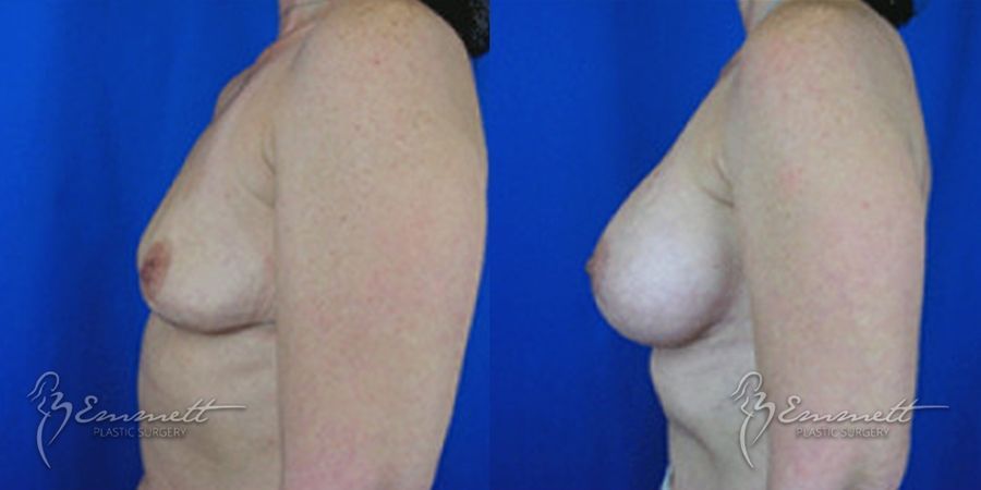 Breast Augmentation - Thumbnail 4