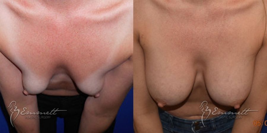 Breast Augmentation - Thumbnail 3