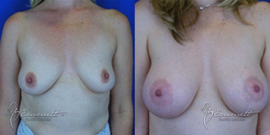 Breast Augmentation - Case 24398