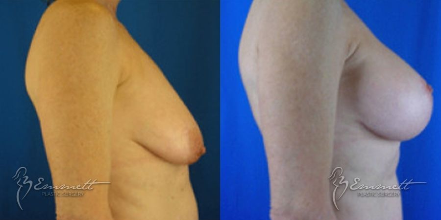 Breast Augmentation - Thumbnail 2