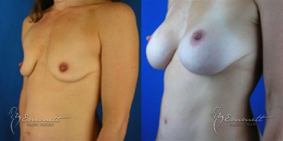Breast Augmentation - Thumbnail 2