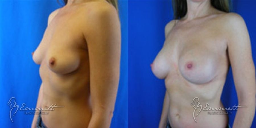 Breast Augmentation - Thumbnail 4
