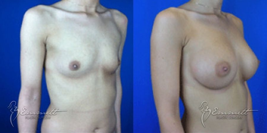 Breast Augmentation - Thumbnail 2
