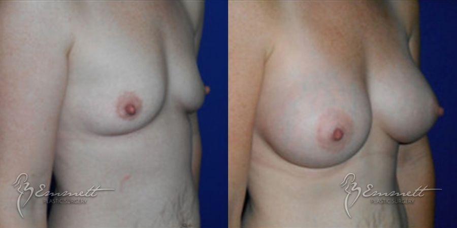 Breast Augmentation - Thumbnail 2