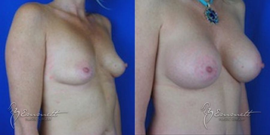 Breast Augmentation - Thumbnail 2
