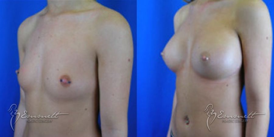 Breast Augmentation - Thumbnail 3