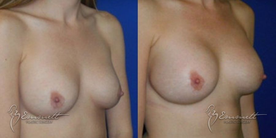 Breast Augmentation - Thumbnail 2