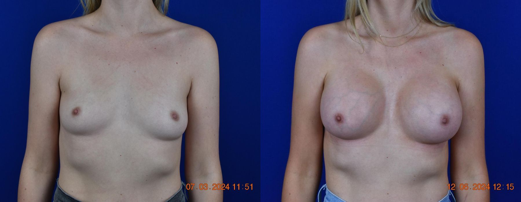 Breast Augmentation - Case 24447