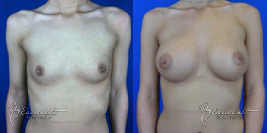 Breast Augmentation - Case 24401