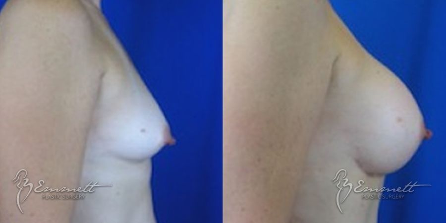 Breast Augmentation - Thumbnail 2