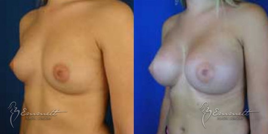 Breast Augmentation - Thumbnail 3